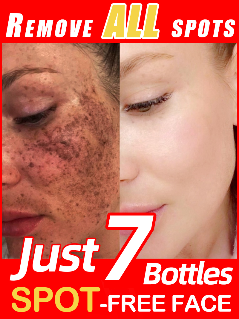 Ultra Luxury Skincare - Zmniejszanie piegów, melazmy, ciemnych plam na